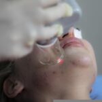 Laser treatment to remove acne scars